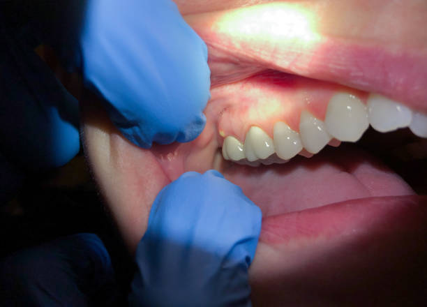 Best Emergency Root Canal Treatment in St Louis Park, MN