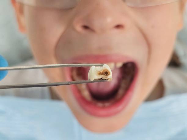 Best Emergency Gum Treatment in St Louis Park, MN